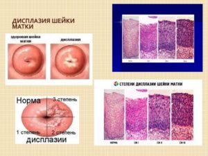 Прогноз при 3 степени дисплазии шейки матки