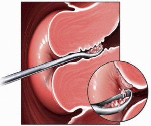 Выскабливание матки
