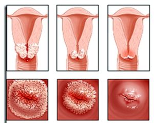 Чем опасна эрозия шейки матки