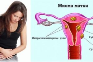 Причины возникновения миомы матки у женщин
