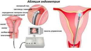 Что такое абляция эндометрия