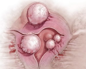 Чем опасна миома матки больших размеров