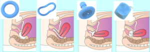 Пессарий на шейку матки