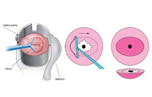 Что такое абляция шейки матки
