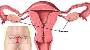 Почему болят яичники при месячных