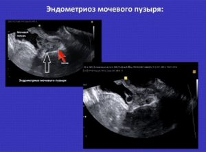 Симптомы эндометриоза мочевого пузыря у женщин