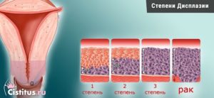 Как лечится дисплазия шейки матки