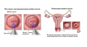 Выделения после конизации шейки матки