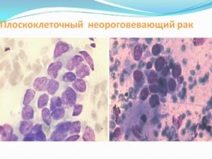 Прогноз при плоскоклеточном неороговевающем раке шейки матки