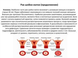 Первые симптомы рака шейки матки у женщин