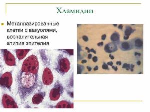 Метаплазированные клетки шейки матки