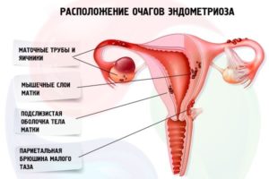 Что такое эндометриоз тела матки