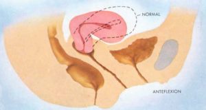 Антефлексия матки