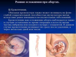 Сокращение матки после аборта