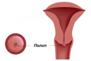 Полипы на шейке матки