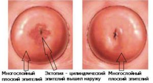 Что значит коническая шейка матки