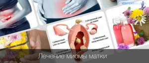 Лечение узловой миомы матки народными средствами