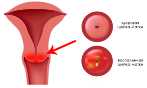 Лечение хронического цервикоза шейки матки