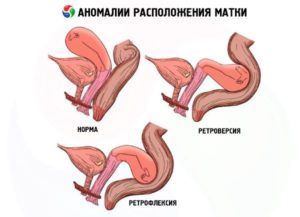 Как понять ретроверсия матки