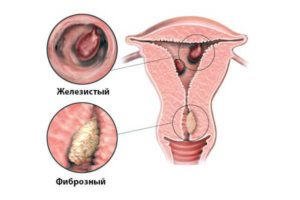 Причины возникновения полипов в матке