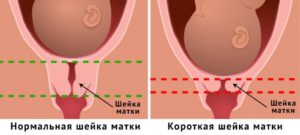 Почему укорачивается шейка матки при беременности