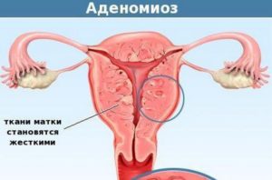 Миома и аденомиоз матки у женщин