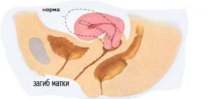Загиб матки кпереди
