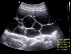 Трехкамерная и двухкамерная киста яичника