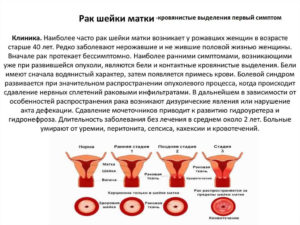 Признаки рака матки на ранних стадиях