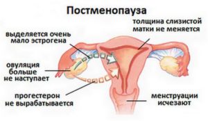 Лечение серозоцервикса