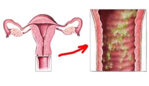 Трихомонадный кольпит симптомы и лечение у мужчин