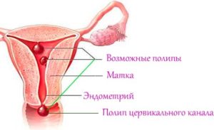 Полип в цервикальном канале шейки матки