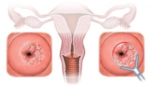Лечение после конизации шейки матки