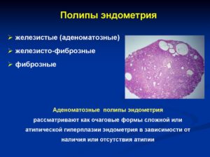 Аденоматозный полип эндометрия
