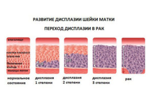 Прогноз при 1 степени дисплазии шейки матки