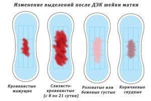 Как отходит струп после конизации шейки матки