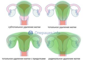 Как называется операция по удалению матки