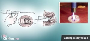 Электрокоагуляция шейки матки