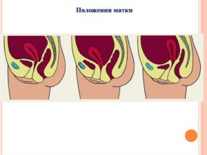 Неправильное расположение матки