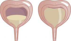 Слабый мочевой пузырь у женщин лечение