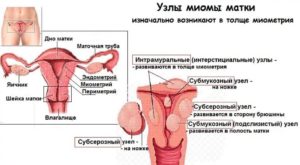 Оперировать или нет субмукозный узел в матке