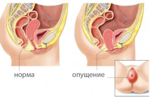 Опущение матки в гинекологии