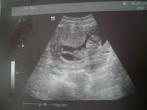 Тонус по передней стенке матки при беременности