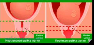 Длинная шейка матки при беременности