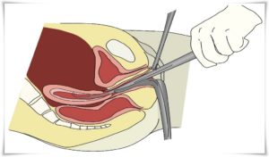 Выскабливание полости матки при кровотечении