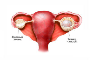 Ретенционное образование правого и левого яичника