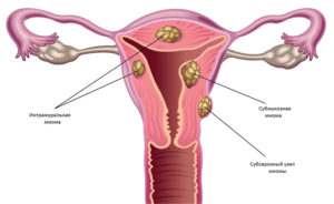 Интрамуральная миома матки