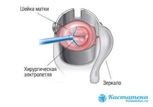 Прижигание кисточек на шейке матки