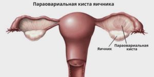Параовариальная киста яичника: лечение без операции