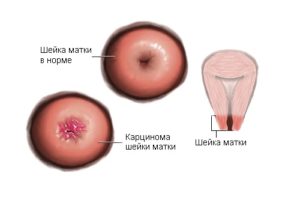 Карцинома шейки матки